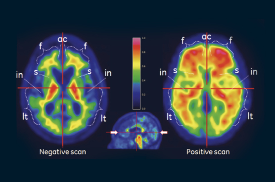 PET imaging of the brain